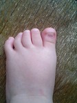 幼児(赤ちゃん)の足の指の変形